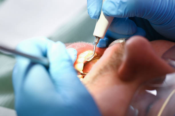 Best Emergency Dental Care for Broken or Chipped Teeth in Gerber, CA