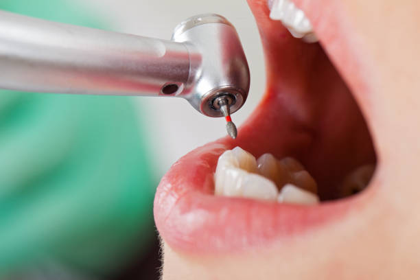 Best Emergency Dental Care for Broken or Chipped Teeth in Gerber, CA